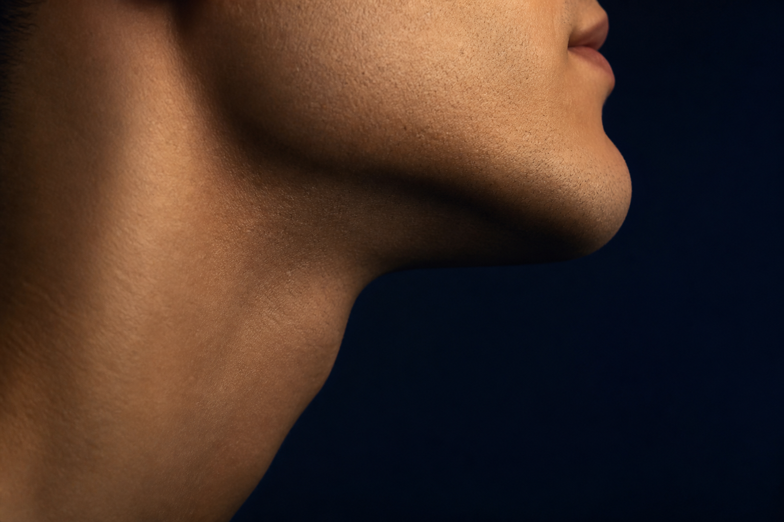 Kybella