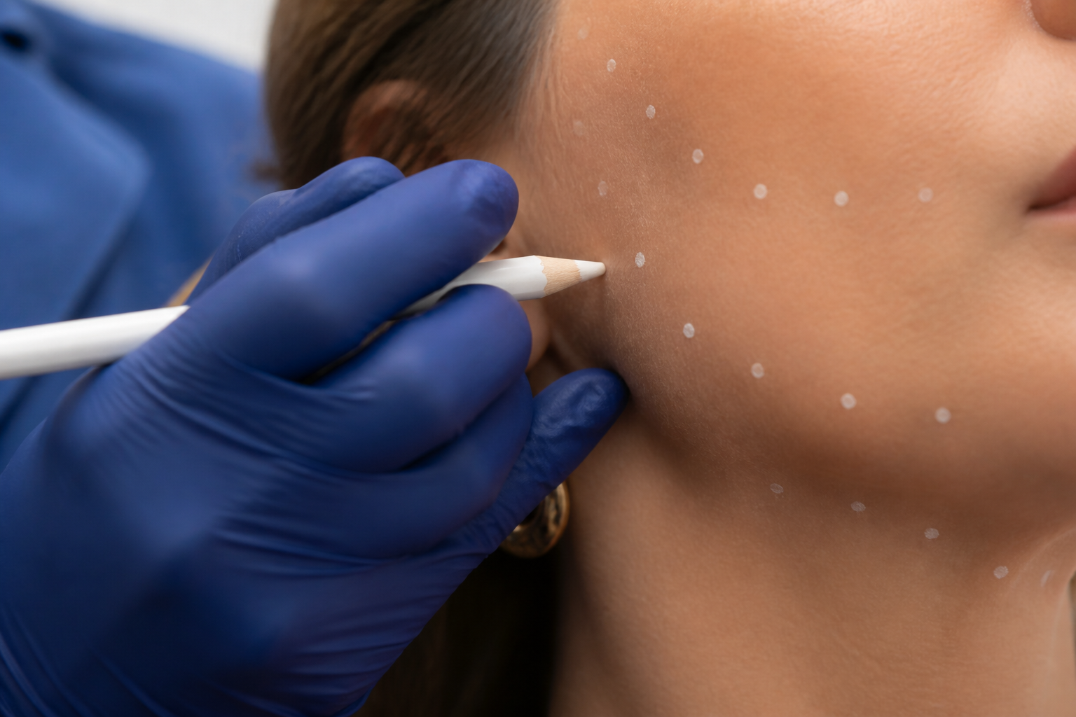 Marking injection points before a dermal filler treatment