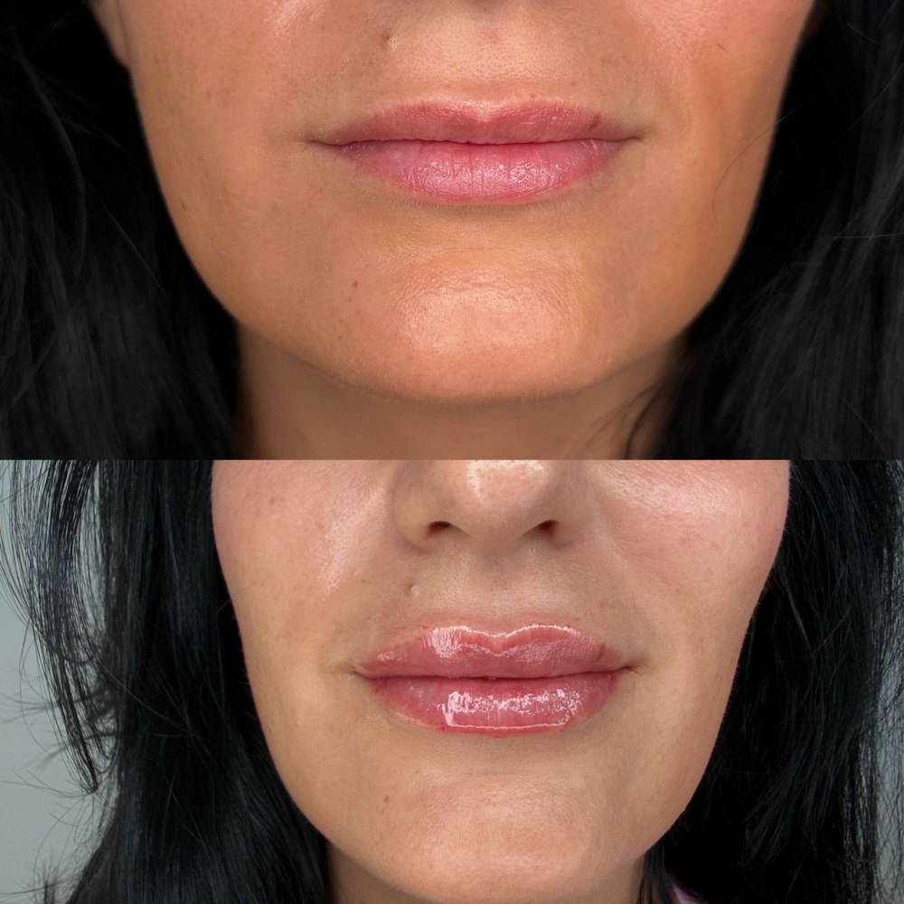 Before and after lip filler on a Beyond Concierge Healthcare patient in Palm Beach County, showing fuller, more defined lips with a natural shape