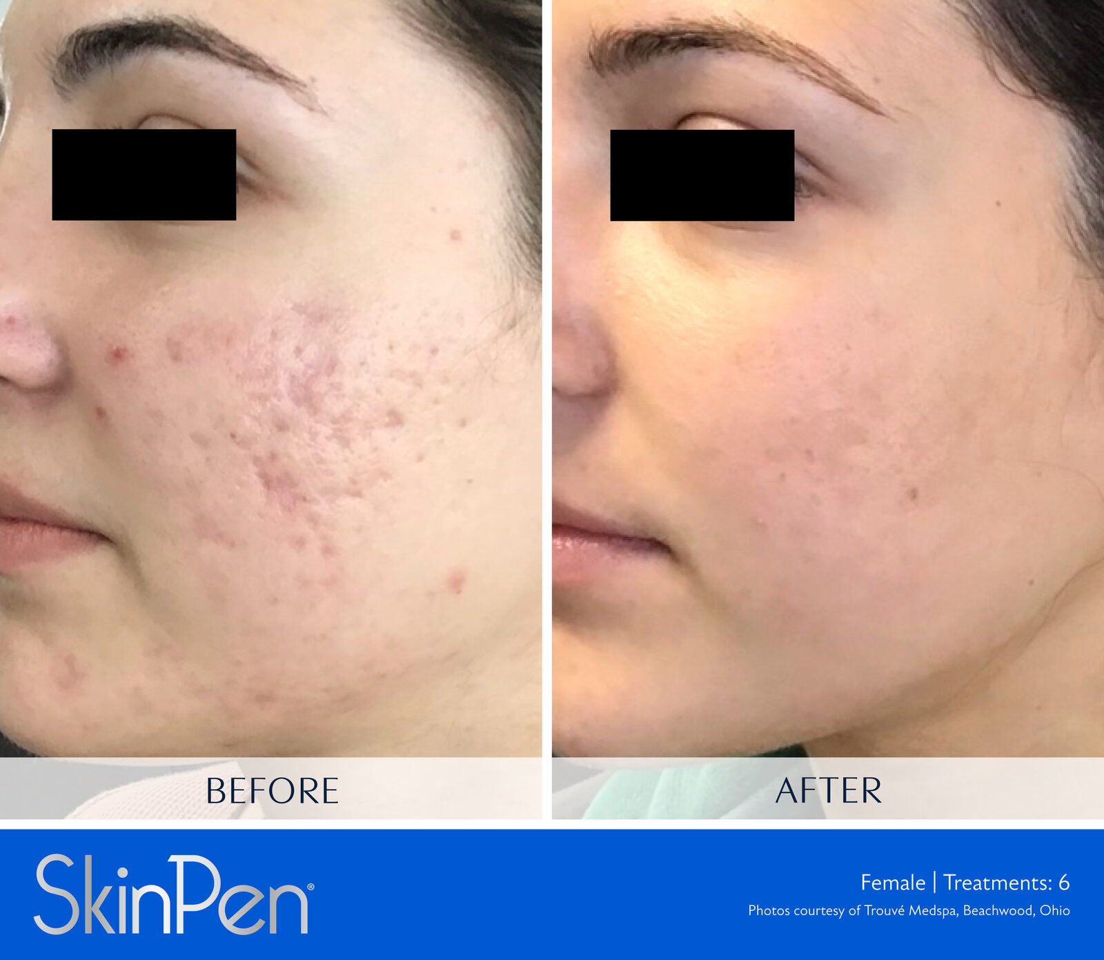 SkinPen before and after, acne scarring, six treatments