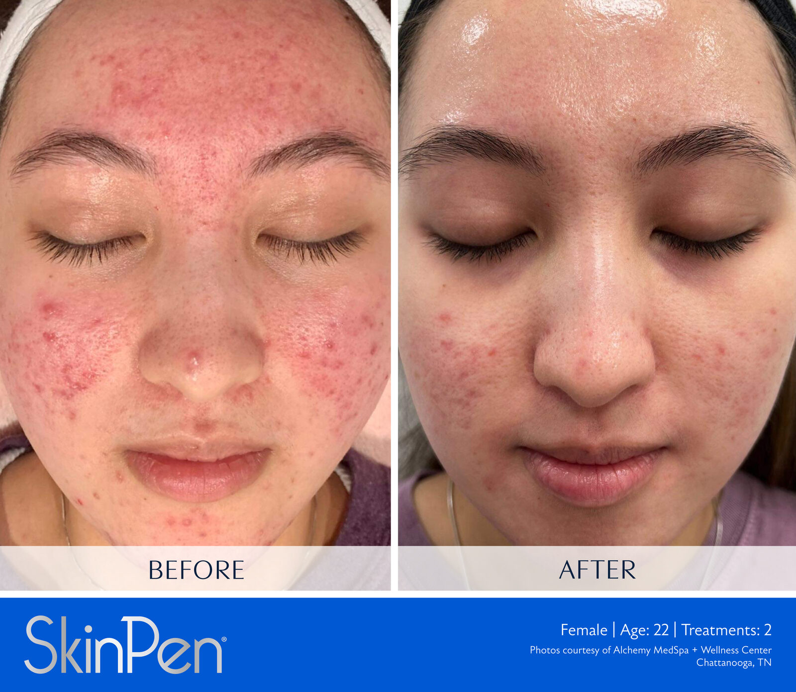 SkinPen before and after, active acne and scarring, female patient age 22, two treatments