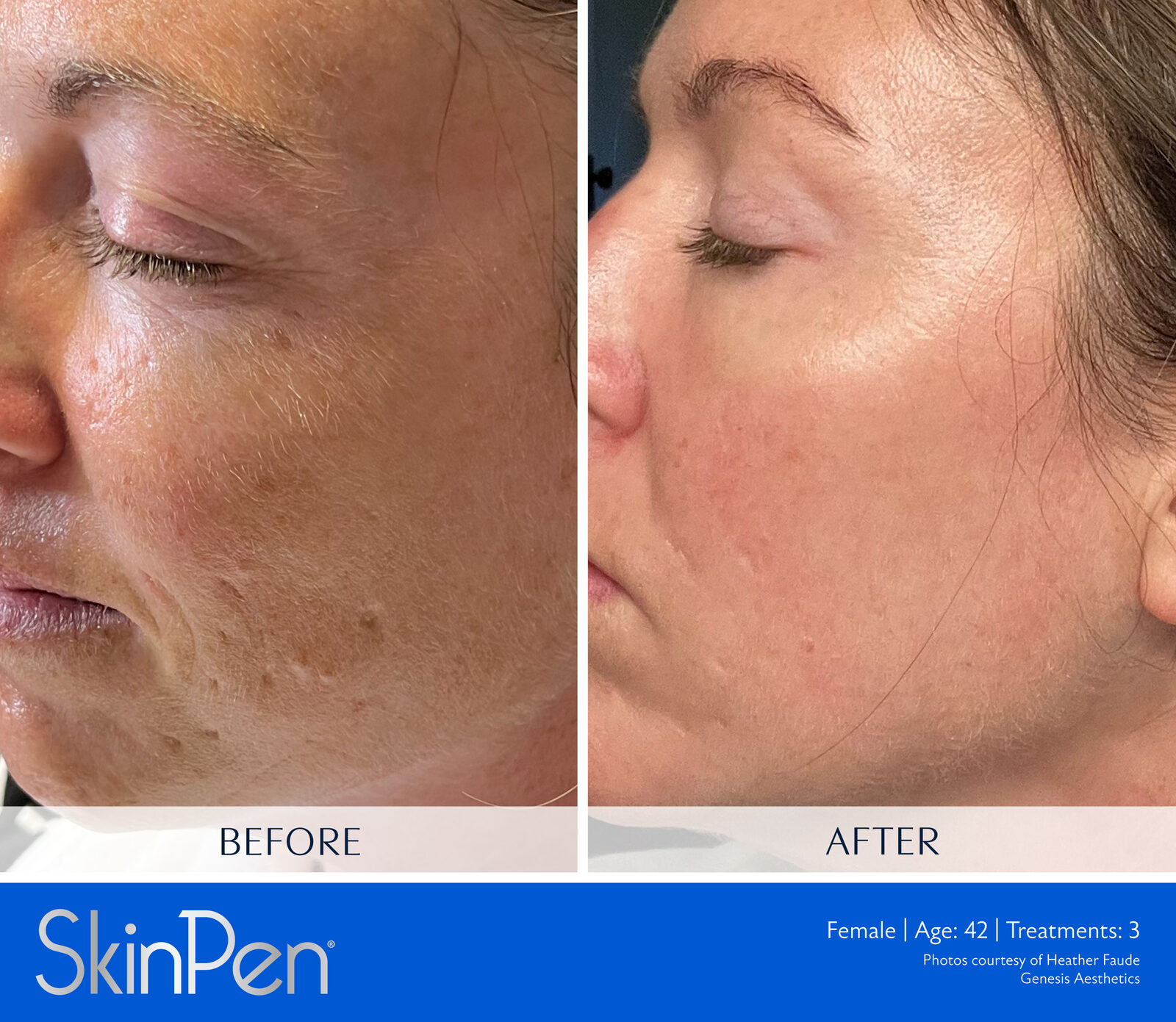 SkinPen before and after, acne scarring, female patient age 42, three treatments