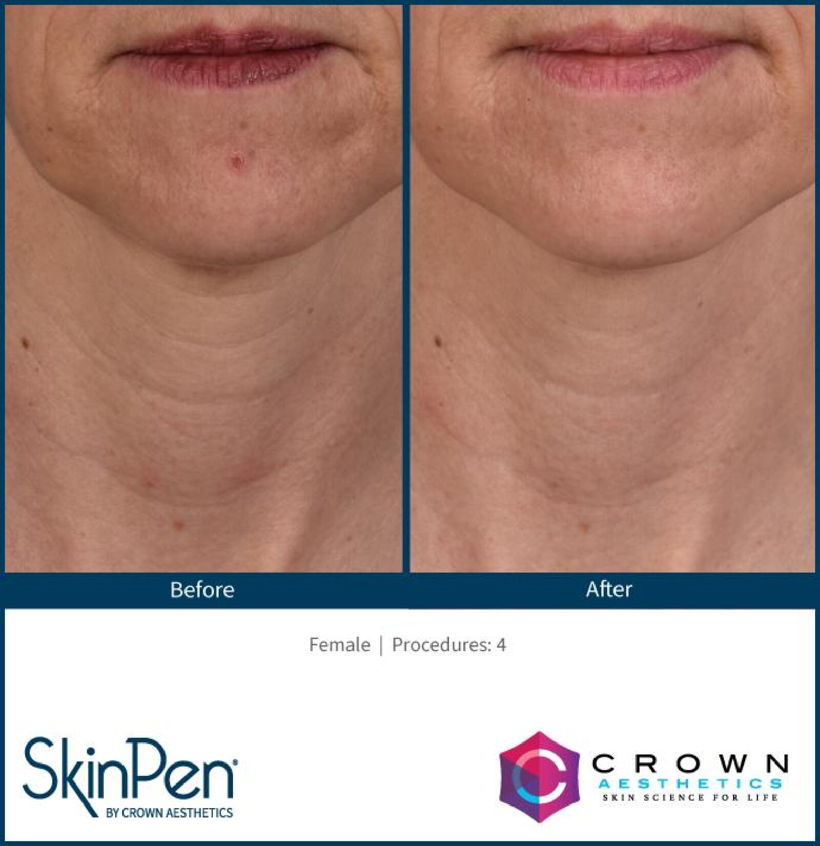 SkinPen before and after, neck wrinkles, four procedures