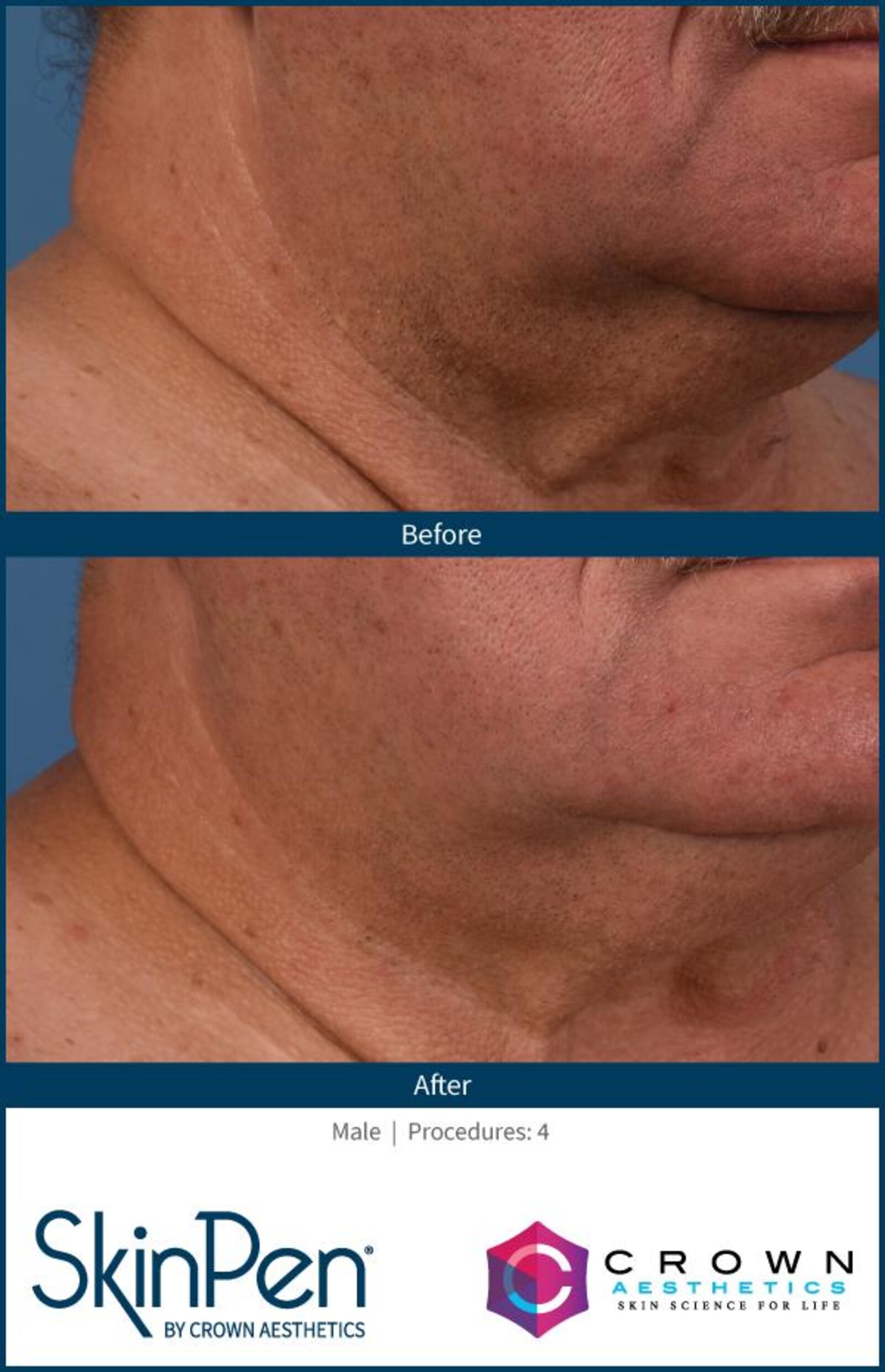 SkinPen before and after, neck wrinkles, three procedures