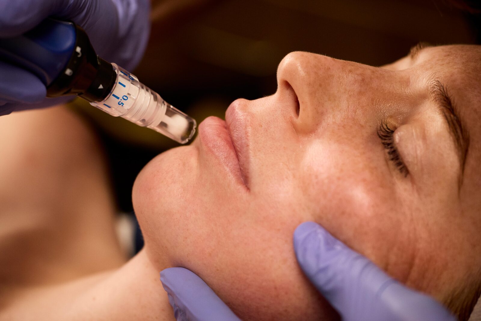 Licensed provider performing SkinPen microneedling